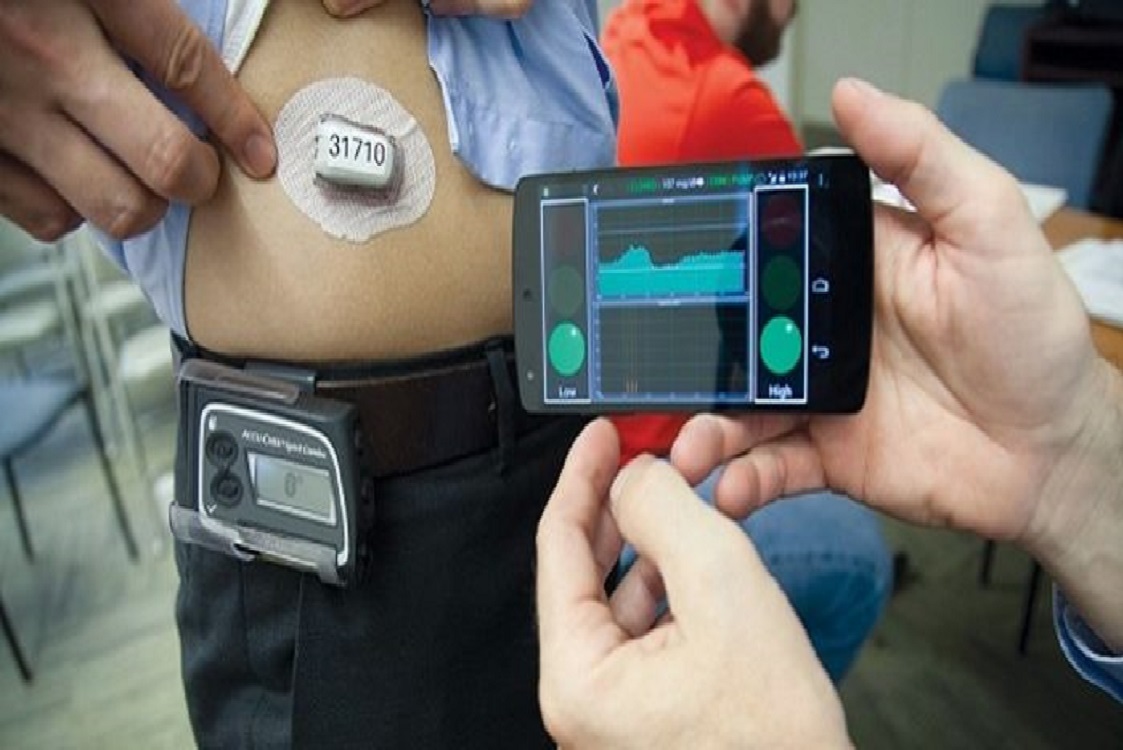 MilanoPost pancreas artificiali